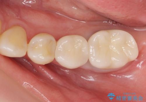 銀歯のやりかえ。の治療後