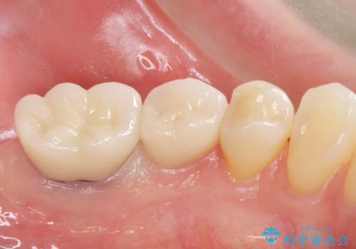 銀歯のやりかえ。の治療後