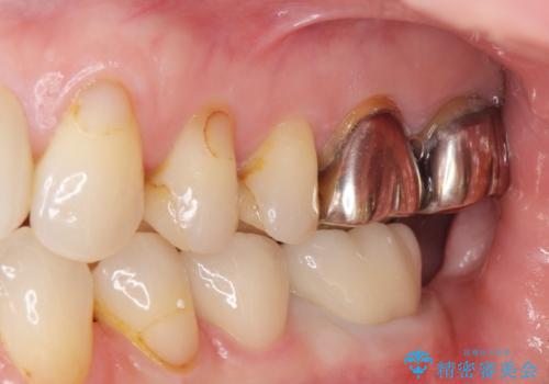 銀歯のやりかえ。の治療後