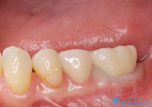 銀歯のやりかえ。の治療後