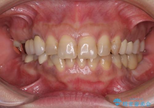 インプラントや歯周外科処置を用いた奥歯の補綴治療の治療後