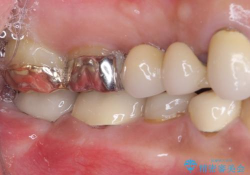 インプラントや歯周外科処置を用いた奥歯の補綴治療の治療後