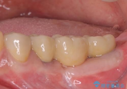 インプラントや歯周外科処置を用いた奥歯の補綴治療の治療後