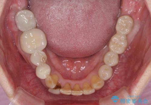 インプラントや歯周外科処置を用いた奥歯の補綴治療の治療後
