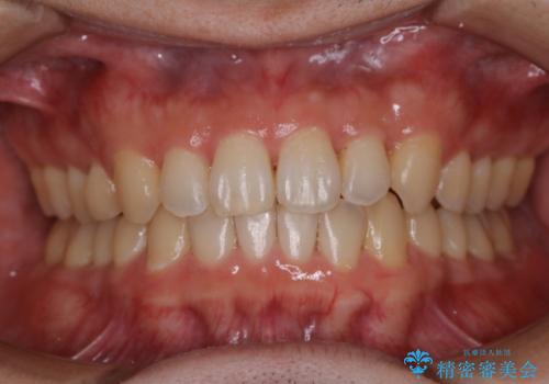 内側に入っていた前歯とガタつきをインビザラインで綺麗に並べるの症例 治療後