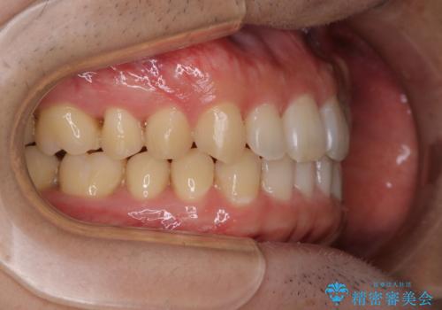 内側に入っていた前歯とガタつきをインビザラインで綺麗に並べるの治療後