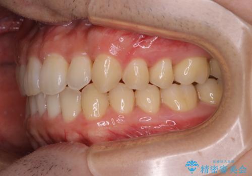 内側に入っていた前歯とガタつきをインビザラインで綺麗に並べるの治療後