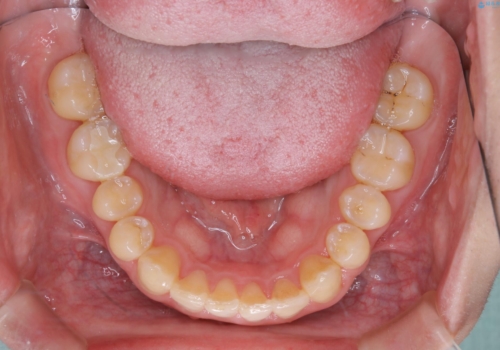 内側に入っていた前歯とガタつきをインビザラインで綺麗に並べるの治療後