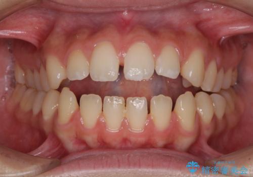 【モニター】隙間だらけの前歯を治したい インビザラインによる矯正治療の症例 治療前