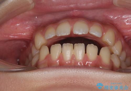 【モニター】隙間だらけの前歯を治したい インビザラインによる矯正治療の治療前