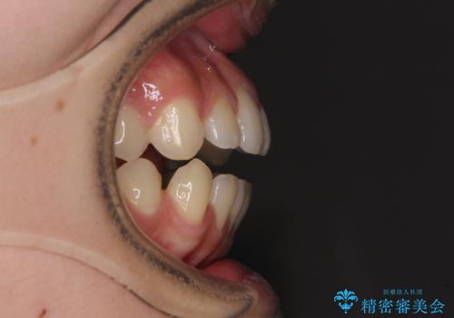 【モニター】隙間だらけの前歯を治したい インビザラインによる矯正治療の治療前