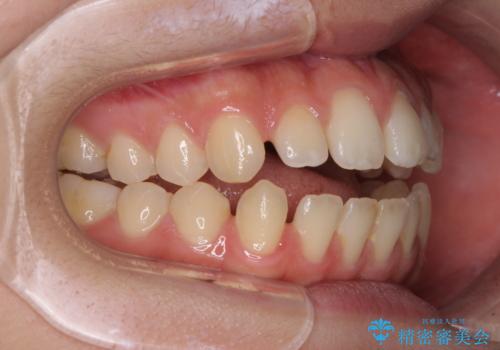 【モニター】隙間だらけの前歯を治したい インビザラインによる矯正治療の治療前