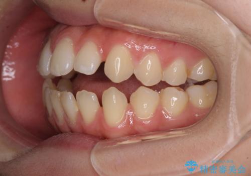 【モニター】隙間だらけの前歯を治したい インビザラインによる矯正治療の治療前