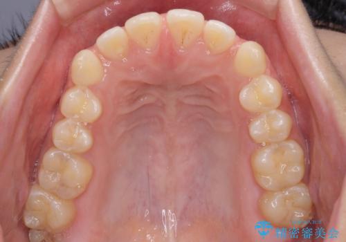 【モニター】隙間だらけの前歯を治したい インビザラインによる矯正治療の治療前