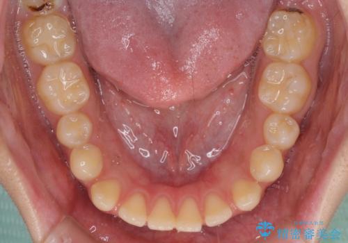 【モニター】隙間だらけの前歯を治したい インビザラインによる矯正治療の治療前