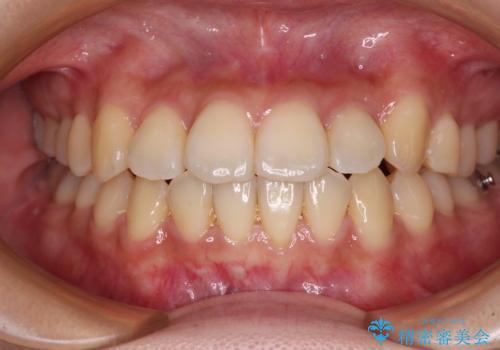 【モニター】前歯のデコボコを改善 ワイヤー矯正を併用したインビザライン矯正の治療中