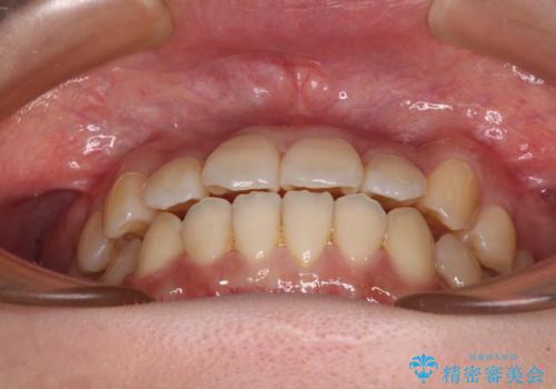 【モニター】前歯のデコボコを改善 ワイヤー矯正を併用したインビザライン矯正の治療中