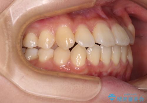 【モニター】前歯のデコボコを改善 ワイヤー矯正を併用したインビザライン矯正の治療中