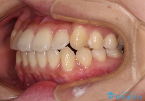 【モニター】前歯のデコボコを改善 ワイヤー矯正を併用したインビザライン矯正の治療中