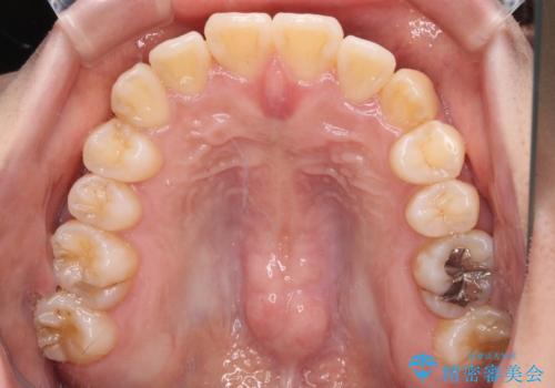 【モニター】前歯のデコボコを改善 ワイヤー矯正を併用したインビザライン矯正の治療中