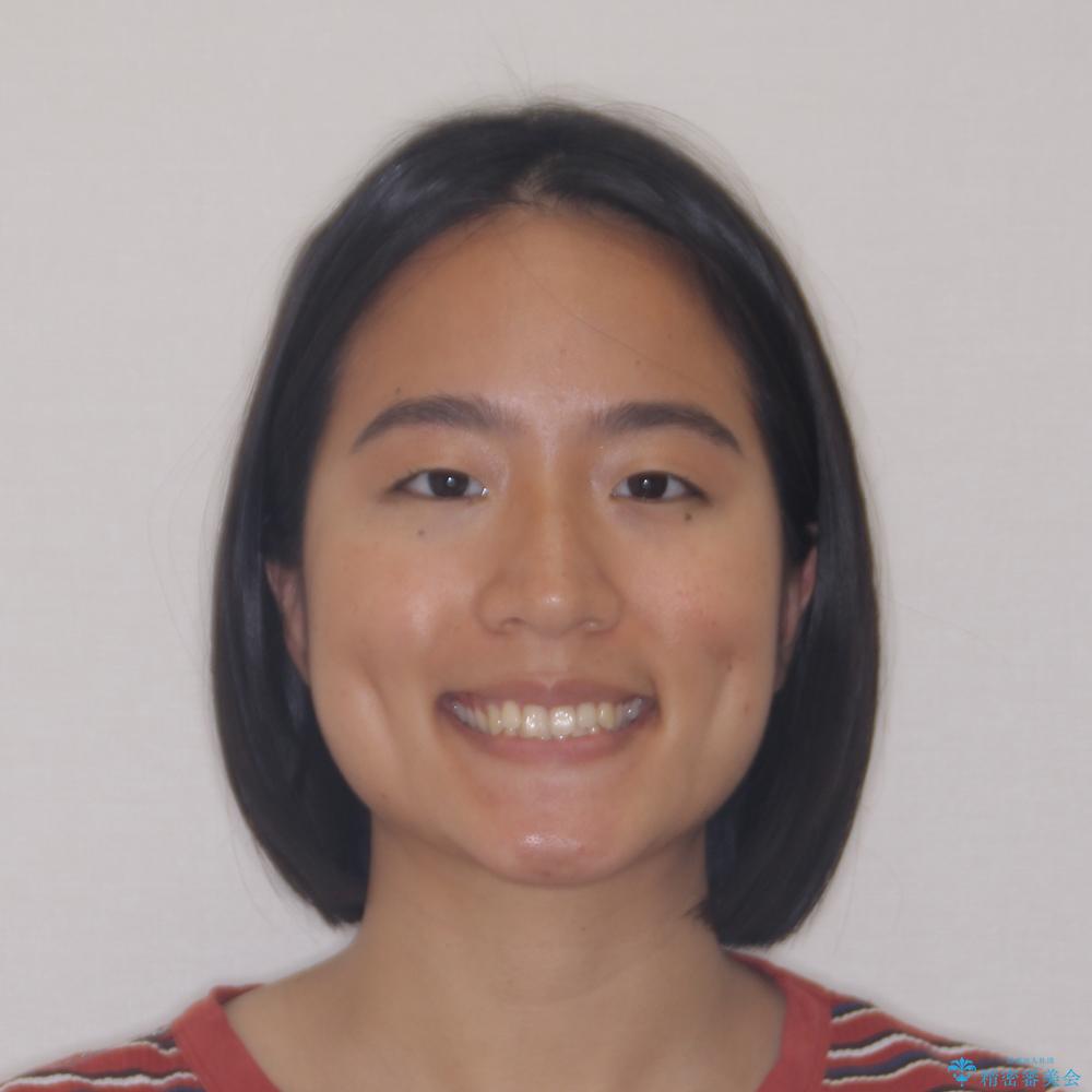 【モニター】下顎の気になる八重歯を改善 インビザラインによる矯正治療の治療前(顔貌)