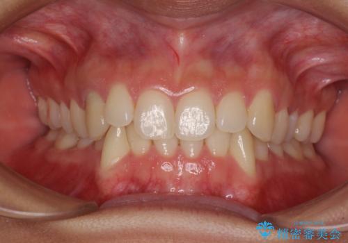 【モニター】下顎の気になる八重歯を改善 インビザラインによる矯正治療の症例 治療前