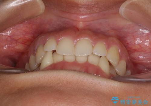 【モニター】下顎の気になる八重歯を改善 インビザラインによる矯正治療の治療前