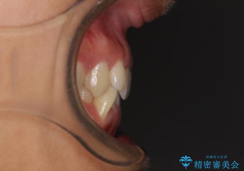 【モニター】下顎の気になる八重歯を改善 インビザラインによる矯正治療の治療前