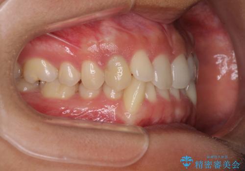 【モニター】下顎の気になる八重歯を改善 インビザラインによる矯正治療の治療前