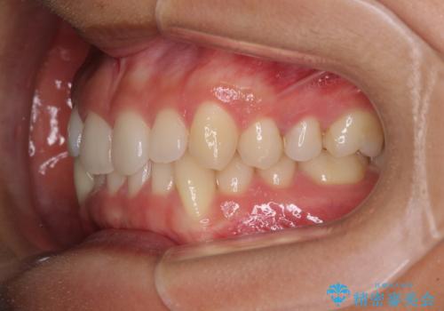【モニター】下顎の気になる八重歯を改善　インビザラインによる矯正治療の治療前