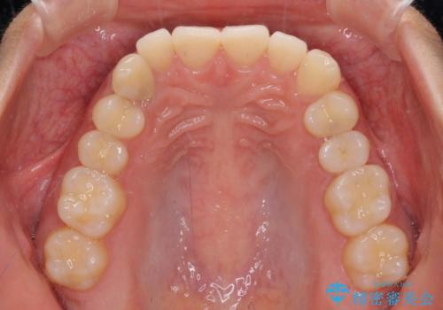 【モニター】下顎の気になる八重歯を改善 インビザラインによる矯正治療の治療前