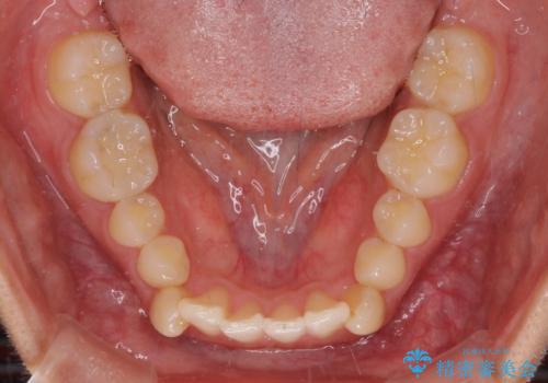 【モニター】下顎の気になる八重歯を改善 インビザラインによる矯正治療の治療前