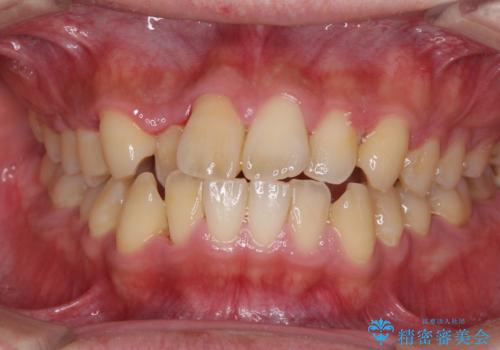 前歯のクロスバイトを改善　インビザラインによる矯正治療の症例 治療前