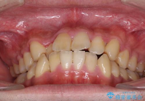 前歯のクロスバイトを改善 インビザラインによる矯正治療の治療前