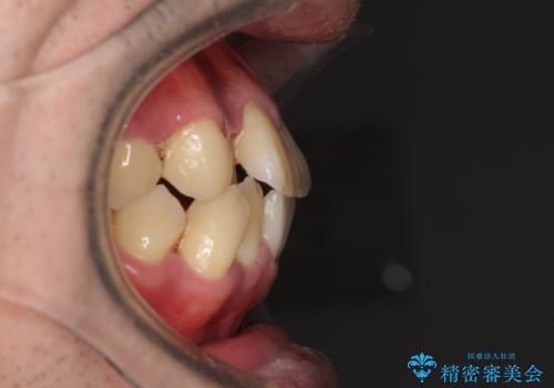 前歯のクロスバイトを改善 インビザラインによる矯正治療の治療前