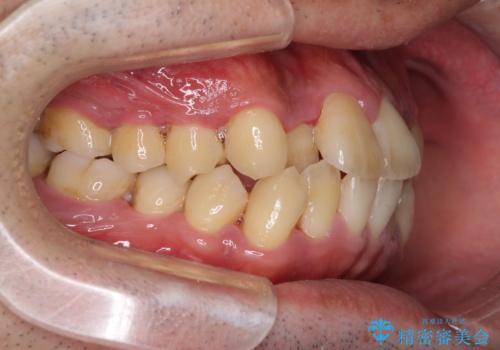 前歯のクロスバイトを改善 インビザラインによる矯正治療の治療前