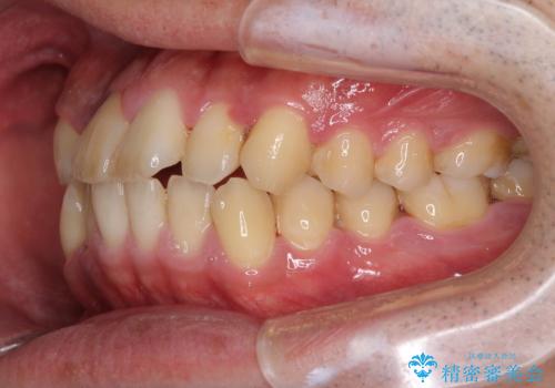 前歯のクロスバイトを改善 インビザラインによる矯正治療の治療前