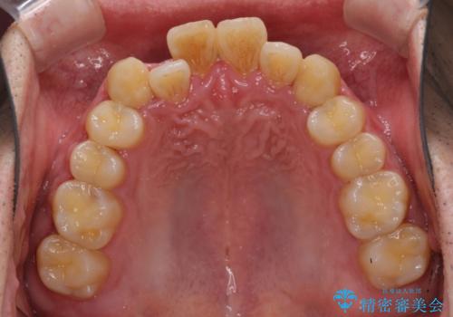 前歯のクロスバイトを改善 インビザラインによる矯正治療の治療前