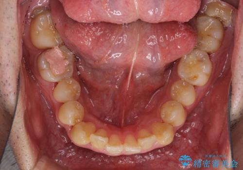 前歯のクロスバイトを改善　インビザラインによる矯正治療の治療前