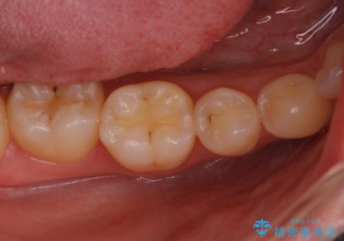 定期検診に来たら虫歯があった。の症例 治療前