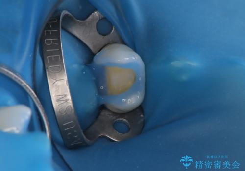 【セラミックインレー】被せ物が欠けたの治療中