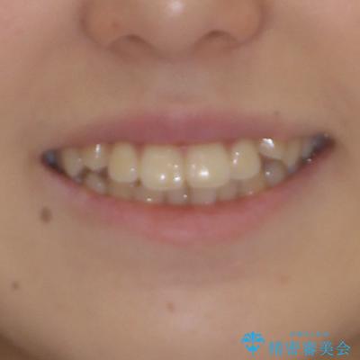 カリエール・ディスタライザーとインビザラインを用いた八重歯の改善の治療前（顔貌）