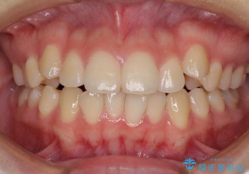 カリエール・ディスタライザーとインビザラインを用いた八重歯の改善の症例 治療前
