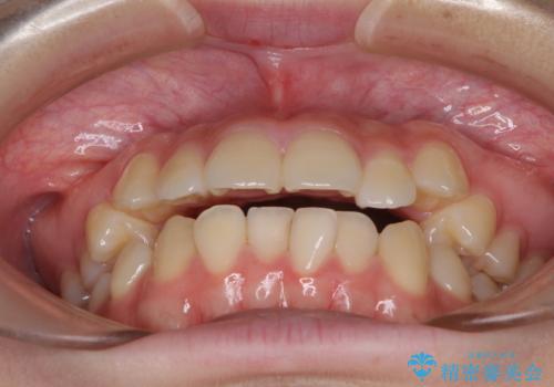 カリエール・ディスタライザーとインビザラインを用いた八重歯の改善の治療前