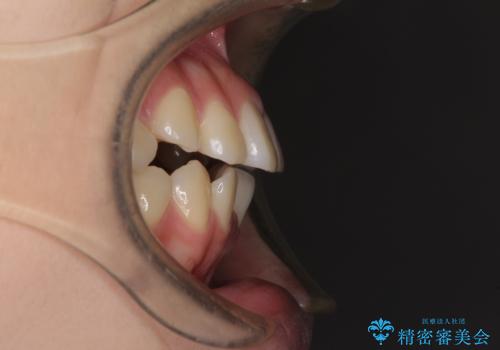 カリエール・ディスタライザーとインビザラインを用いた八重歯の改善の治療前