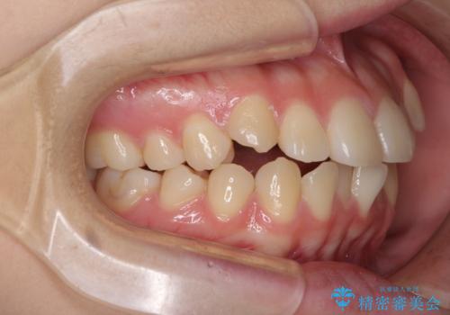 カリエール・ディスタライザーとインビザラインを用いた八重歯の改善の治療前