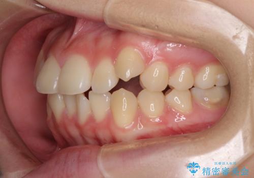 カリエール・ディスタライザーとインビザラインを用いた八重歯の改善の治療前