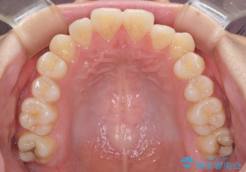 カリエール・ディスタライザーとインビザラインを用いた八重歯の改善の治療前