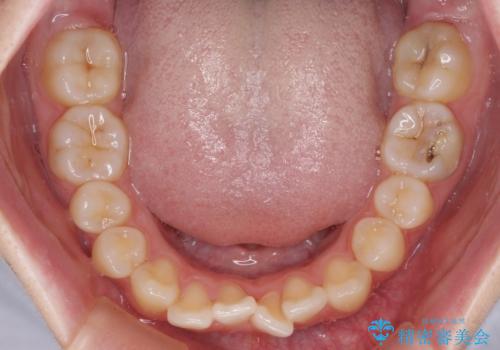 カリエール・ディスタライザーとインビザラインを用いた八重歯の改善の治療前