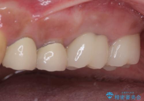 インプラントや歯周外科処置を用いた奥歯の補綴治療の治療後